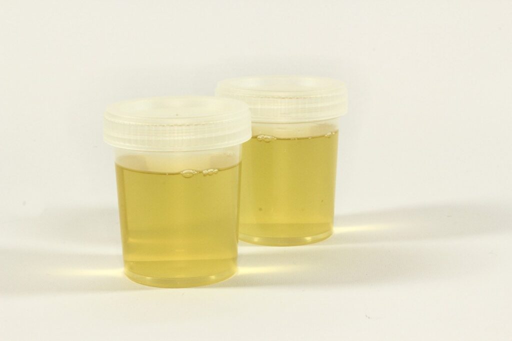 analiza urina